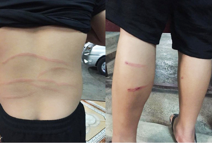 Cháu Nguyễn Chí Bình chằng chịt vết thương.