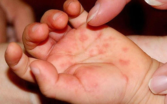 Bệnh sốt xuất huyết đang lây lan ở mức độ báo động