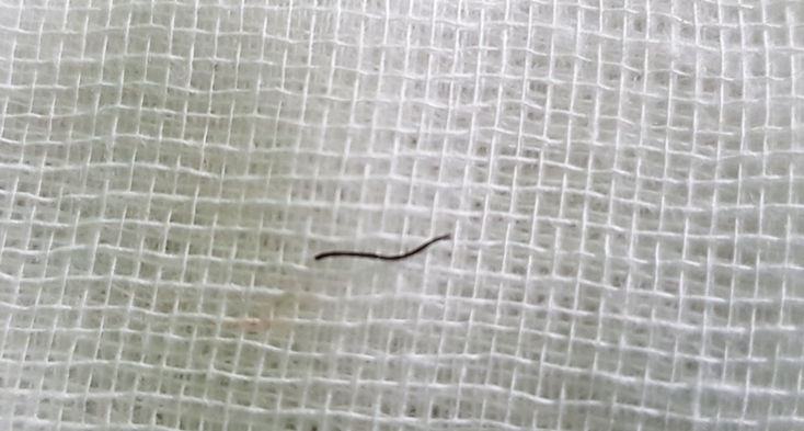 Mảnh sắt 7mm được lấy ra khỏi mắt bệnh nhân.