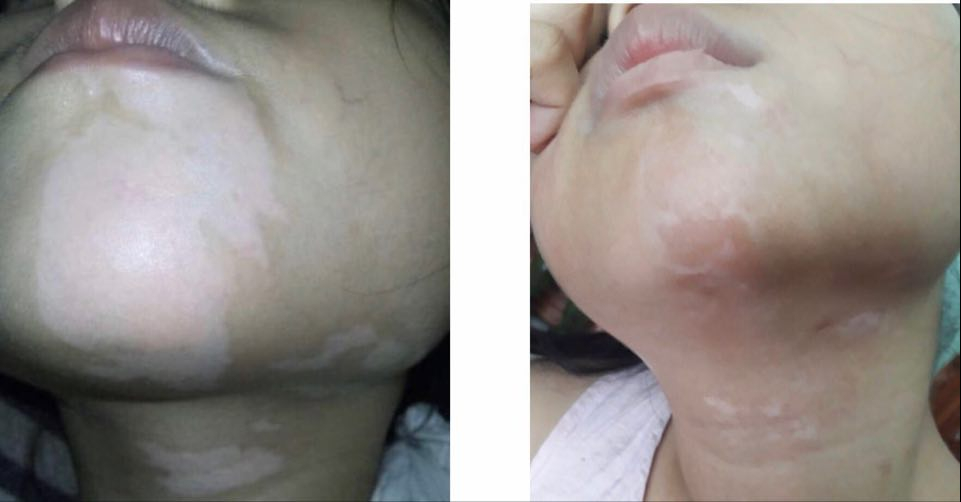 Bệnh bạch biến sau khi điều trị. Ảnh: BV