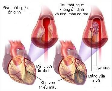  Các cơn đau thắt ngực và bệnh động mạch vành. Ảnh: BV