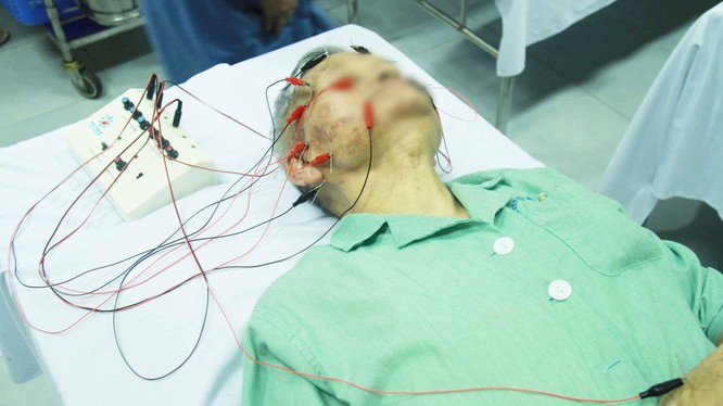  Điều trị cho người bệnh bị liệt mặt. Ảnh: BV