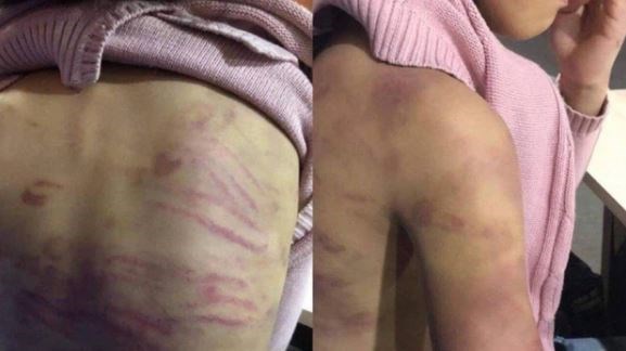 Các vết bầm tím trên người cháu B.