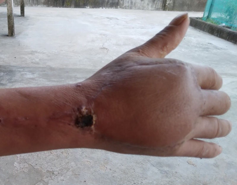  Bàn tay của bệnh nhân sau phẫu thuật.