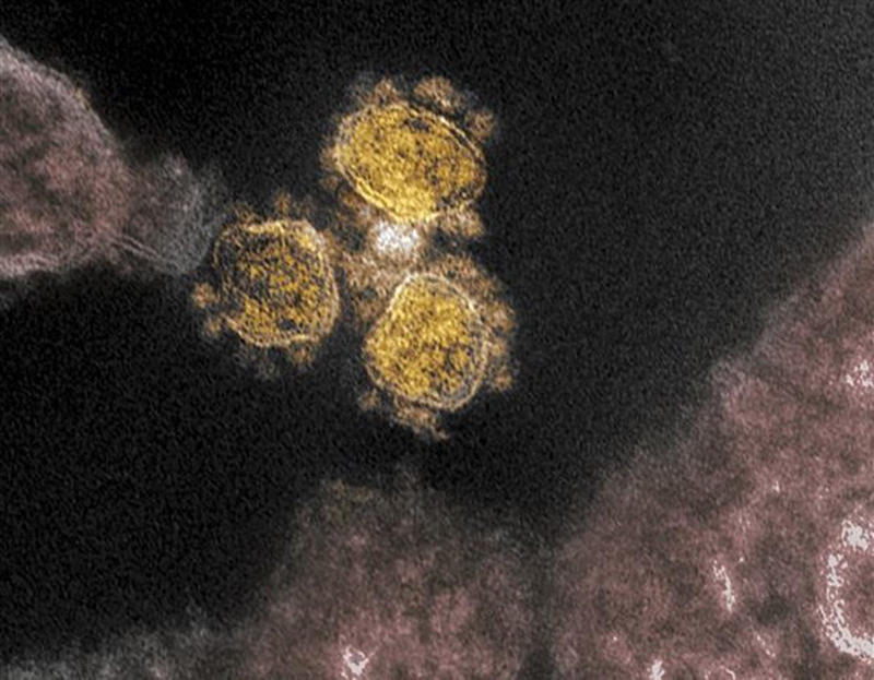Hình ảnh quét qua kính hiển vi điện tử cho thấy virus SARS-COV-2 trên một mẫu bệnh phẩm của bệnh nhân COVID-19. (Ảnh: AFP/TTXVN)