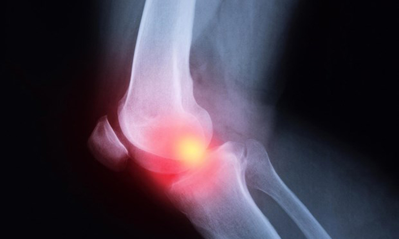 Những người sử dụng NSAID bị viêm khớp nặng hơn. (Nguồn: scitechdaily.com)