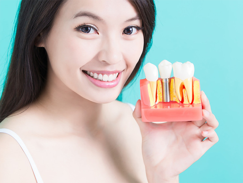 Cấy ghép Implant là kỹ thuật phục hình răng đã mất hoàn hảo