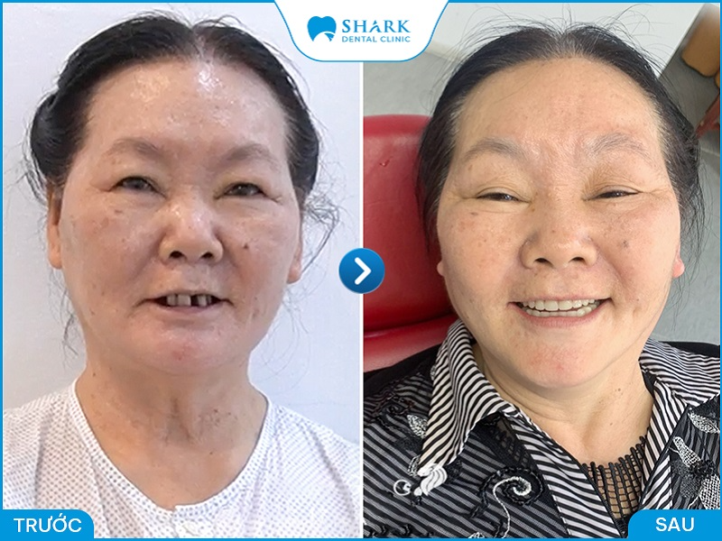 Hình ảnh khách hàng cấy ghép Implant tại nha khoa Shark
