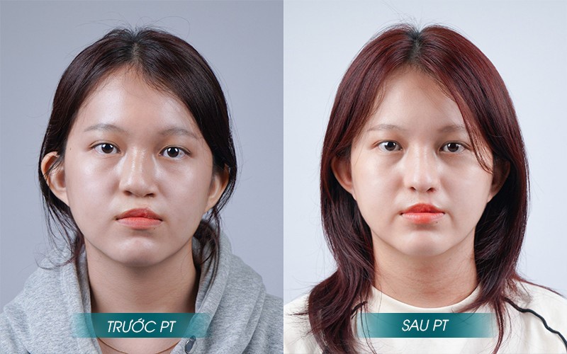 Chương trình Vì sống là sẻ chia tái sinh diện mạo cho hơn 10.000 ca sứt môi hở hàm ếch