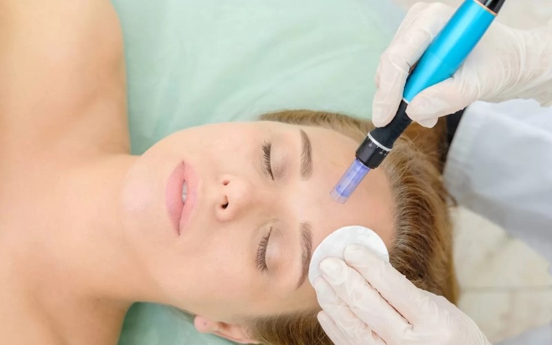 Vi kim là một thủ thuật làm đẹp không xâm lấn giúp sản sinh collagen và elastin
