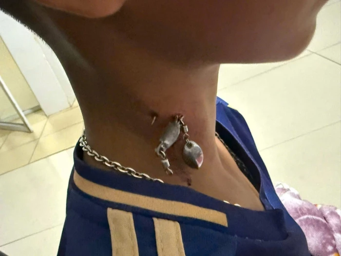 Hy hữu lưỡi câu cá cắm sâu vùng cổ nam thiếu niên