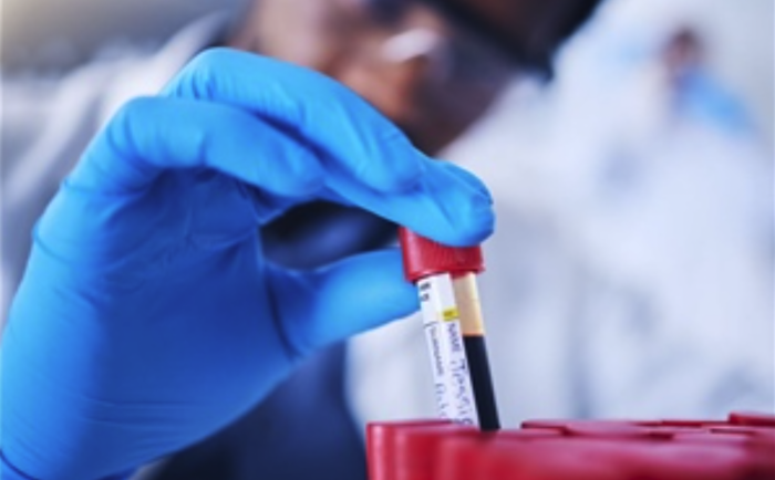 Phát triển phương pháp xét nghiệm máu dự báo nguy cơ tái phát ung thư vùng đầu-cổ