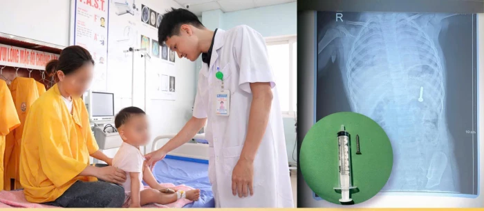 Nội soi cấp cứu bé 21 tháng tuổi nuốt đinh vít dài 2,5cm