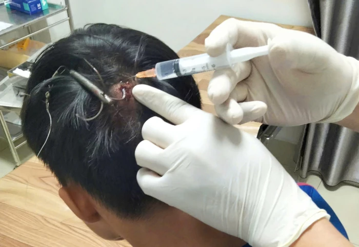 Tai nạn hy hữu: Móc câu 3 tiêu cắm vào đỉnh đầu thiếu niên