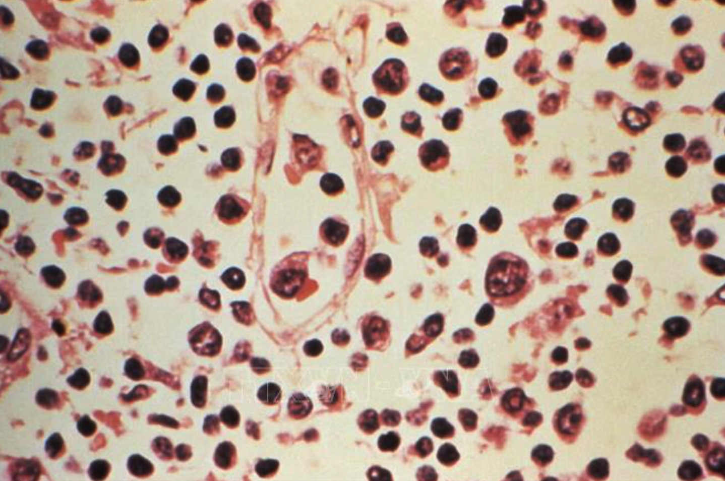 Mẫu bệnh phẩm của một bệnh nhân nhiễm virus Hanta. Ảnh: Reuters/TTXVN