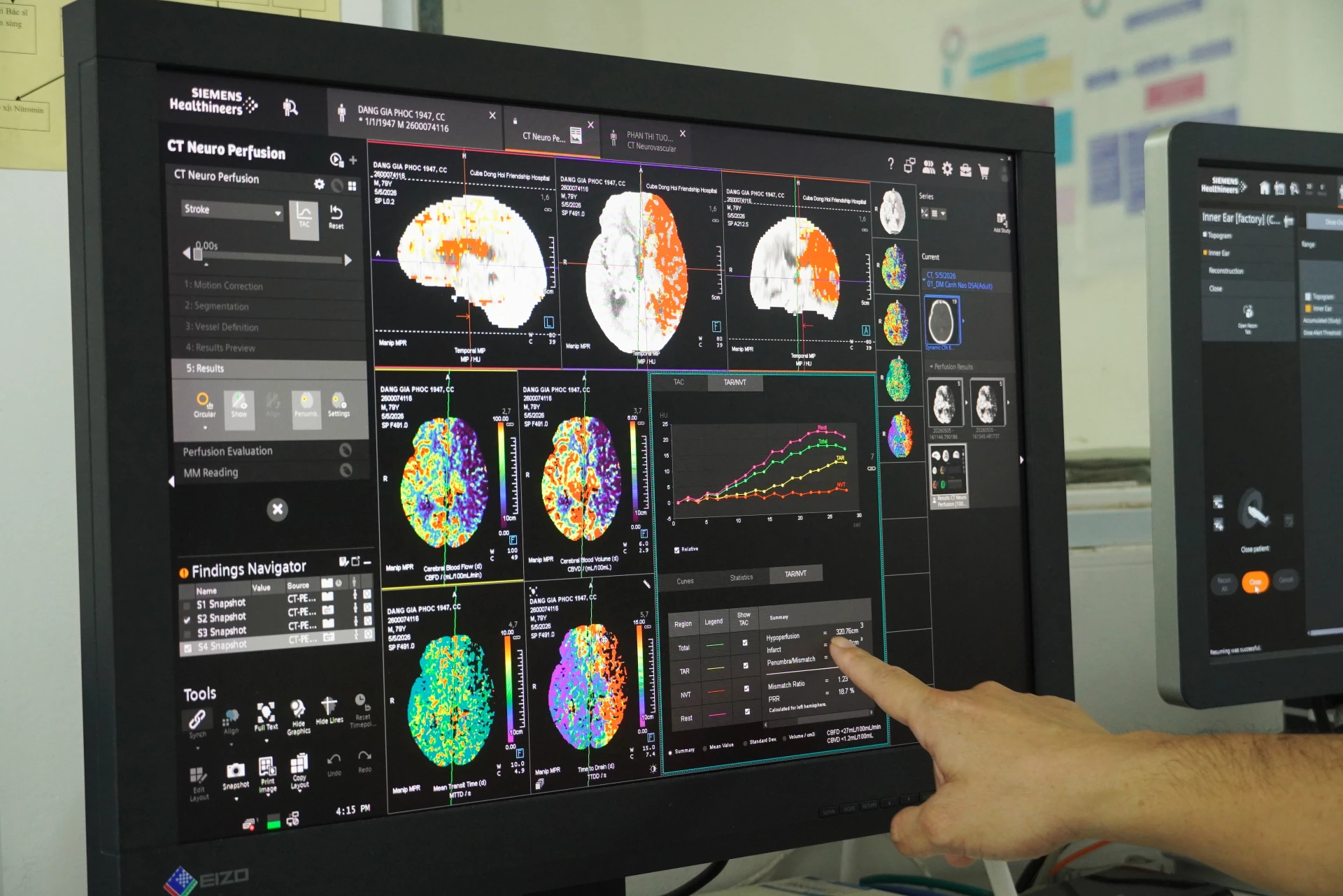 Ứng dụng CT PERFUSION giúp đánh giá vùng lõi nhồi máu não và vùng thiếu máu não còn khả năng phục hồi-điều mà trước đây gần như không thể xác định chính xác bằng mắt thường-Ảnh: H.L