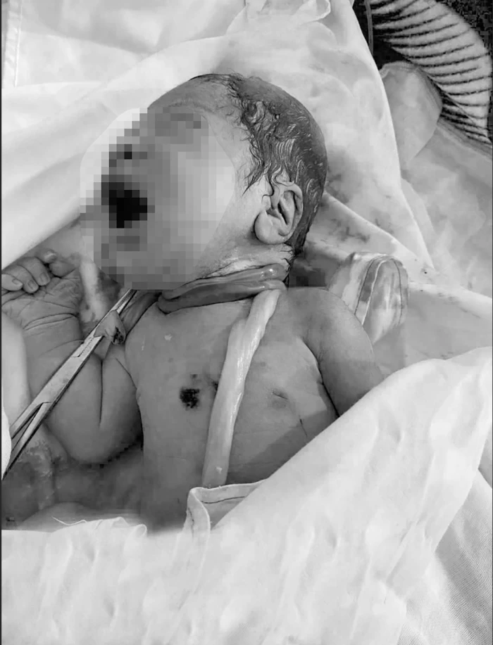 Bé sơ sinh chào đời với dây rốn quấn 6 vòng quanh cổ