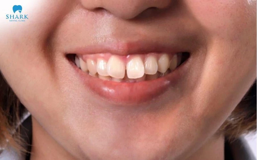 Mức độ răng hô và tình trạng khớp cắn sẽ có thể ảnh hưởng trực tiếp đến chi phí niềng răng