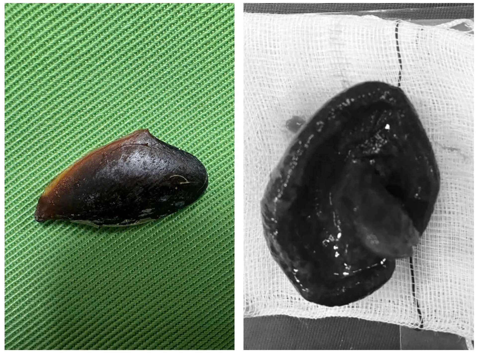 Qua nội soi phế quản, đã phát hiện nhiều dị vật bị mắc khi gặp tai nạn trong lúc ăn uống - Ảnh H.L.