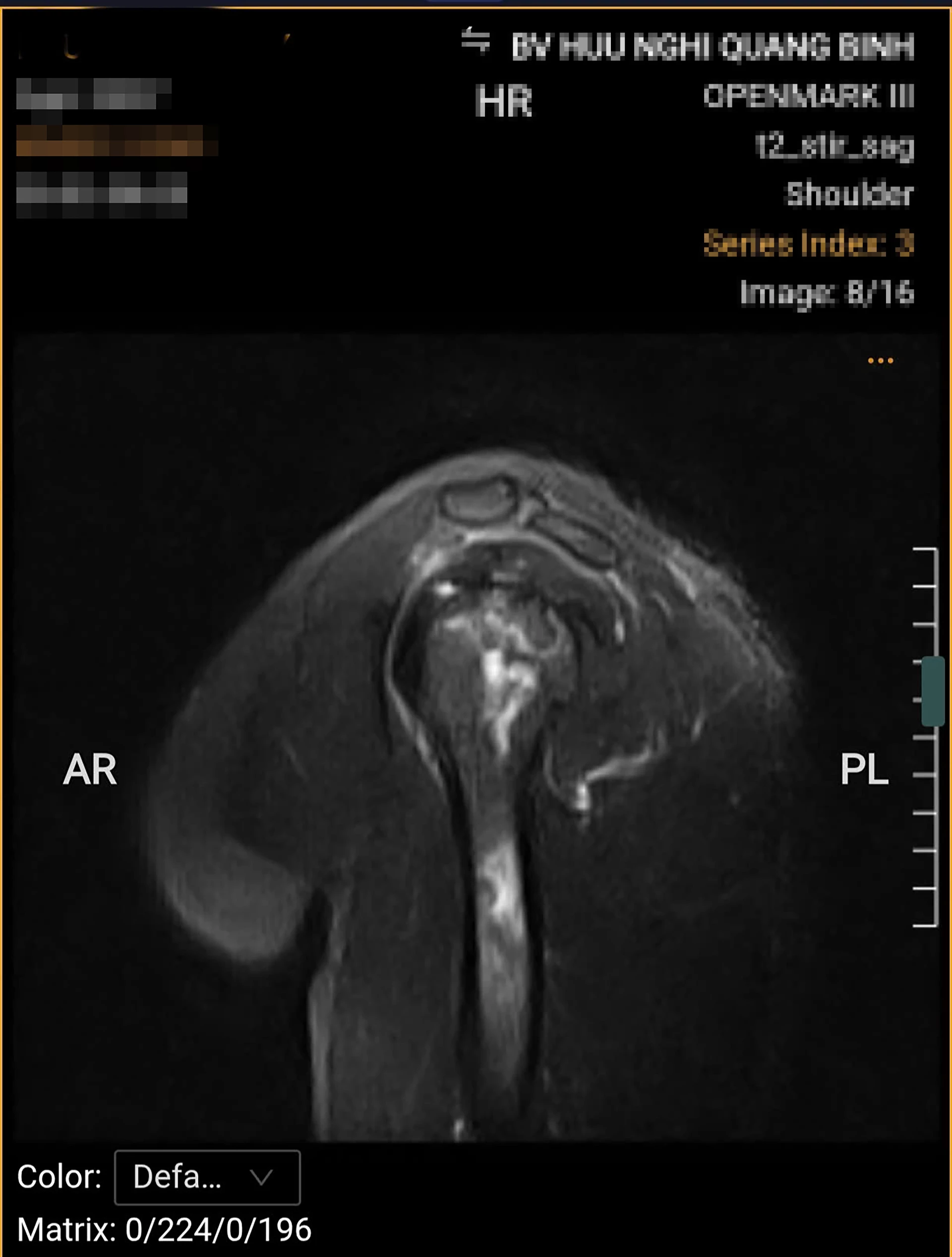 Bệnh nhân bị hoại tử chỏm xương cánh tay trái.