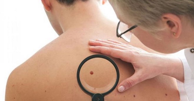 Báo động gia tăng bệnh ung thư da của nam giới tại những nước giàu