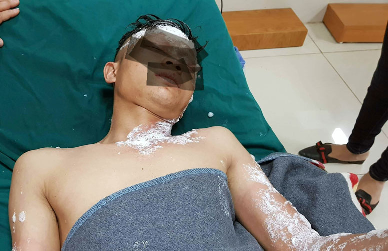 Thanh niên bỏng nặng vì đốt pháo tự chế