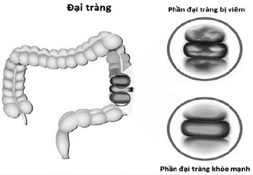 Nỗi khổ khi bị viêm đại tràng mạn
