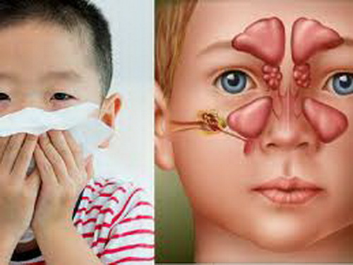 Dấu hiệu trẻ viêm xoang