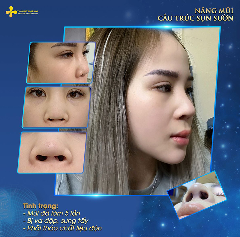 Kinh nghiệm nâng mũi sụn sườn và giải đáp những thắc mắc bạn không nên bỏ lỡ